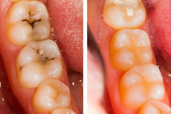 https:South Gate Smile Dental services - Cavity Filing Cost