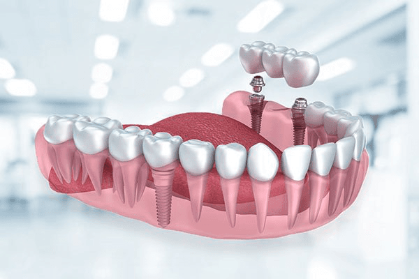 https:Most common All on 4 Bridge problems and how to prevent them.