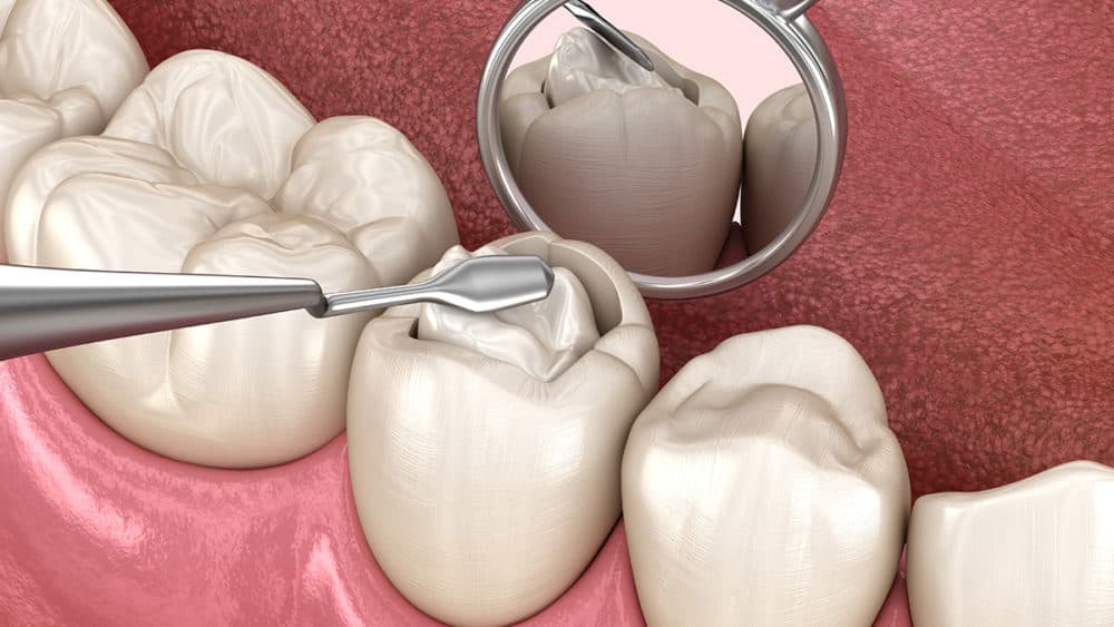 https:A detailed 3D illustration of a dentist placing a filling in a molar tooth. Used in the blog “Cavity Filling Cost: FAQs Every Patient Should Know” by South Gate Smile Dental, highlighting common patient questions about cavity fillings, insurance, and treatment in South Gate, CA.