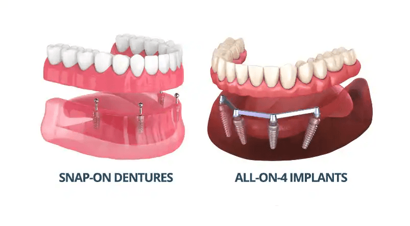 https:South Gate Smile Dental offers dentures and all on 4 south gate smile dental