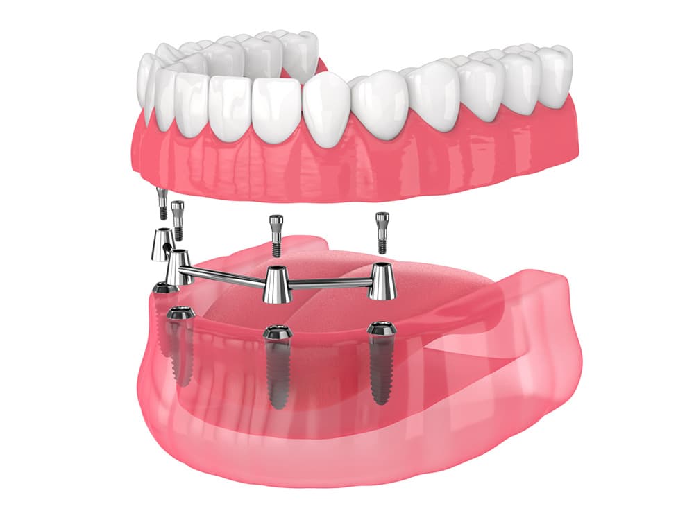https:South Gate Smile Dental, CA offers All-On-4 Dental Implant Services