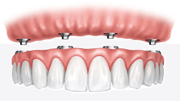 https:Learn how South Gate Smile Dental helps patients care for implants long-term.